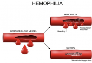 3 blood vessels are displayed; one is damaged, one displays how clotting protein will heal a normal cell, and one shows how coagulation fails in the cell with hemophilia.
